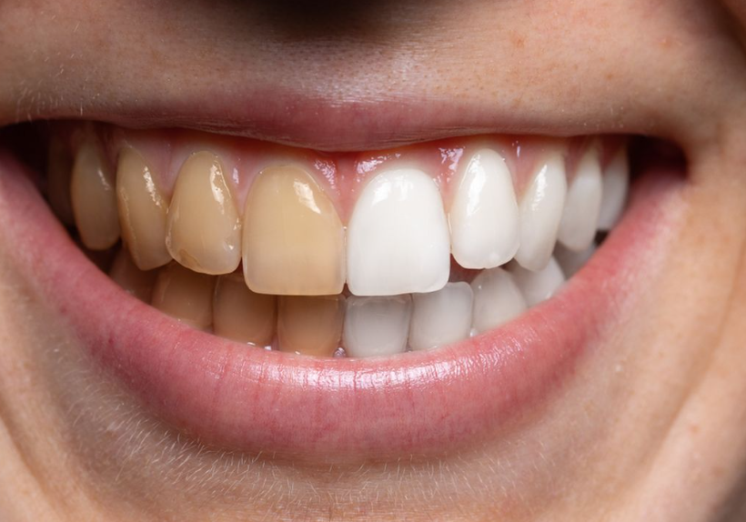 Cara Mengembalikan Gigi Putih